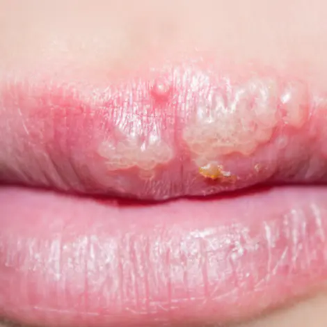 Labial Genital Oculaire Comment Soigner L Herpes Allodocteurs
