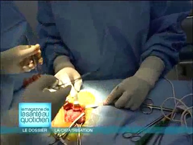Attention, images d'intervention chirurgicale : la cicatrice dépend de la technique choisie par le chirurgien.