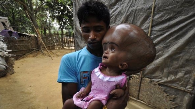 Inde : l'opération de la fillette hydrocéphale est un succès