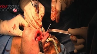 Chirurgie de la mâchoire : les Sud-Coréennes sous-évaluent les risques