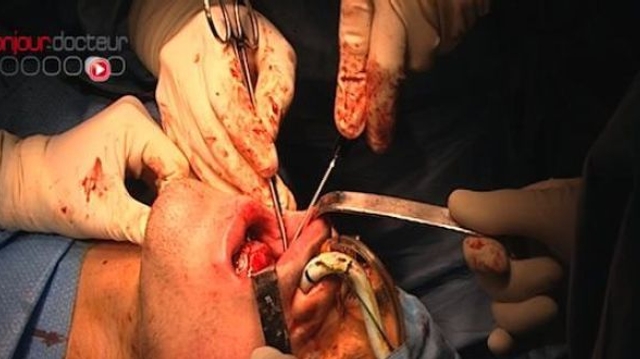 Chirurgie de la mâchoire : les Sud-Coréennes sous-évaluent les risques
