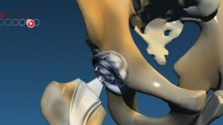 Les prothèses orthopédiques Ceraver sont retirées du marché