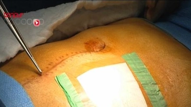 Traiter d'urgence les occlusions intestinales