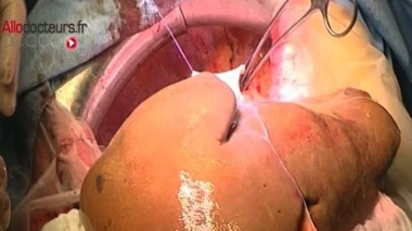 Au Pérou, un cancer du foie touche les jeunes