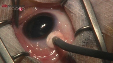 Rétinoblastome : un cancer de la rétine