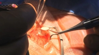 Un placenta pour soigner la cornée