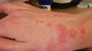 Hôpital de Montbéliard : grand nettoyage contre l'épidémie de gale