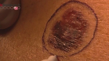 Le mélanome, aussi appelé cancer du grain de beauté, est un cancer extrêmement agressif de la peau.