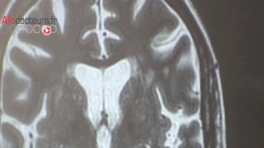La migraine pourrait altérer les structures du cerveau à long terme