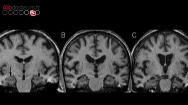 Alzheimer : une molécule néfaste passée inaperçue