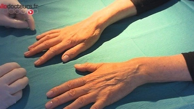 Une chimiothérapie effacerait les empreintes digitales (image d'illustration)