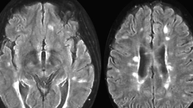Sclérose en plaques : toujours plus de cas dans le monde ?