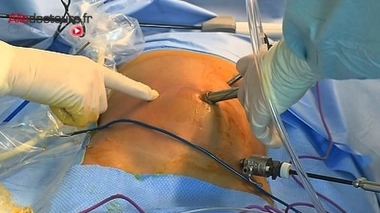 Les kystes digestifs du nourrisson