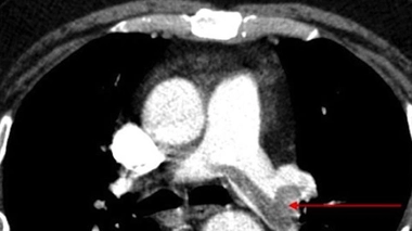 Thromboses veineuses et embolies pulmonaires restent fréquentes en France