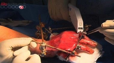 Les progrès de la greffe de peau