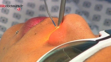 Rhume chronique : les solutions pour déboucher le nez