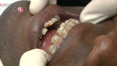 Orthodontie : pour les adultes aussi