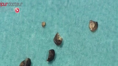 Ch@t : Les calculs rénaux