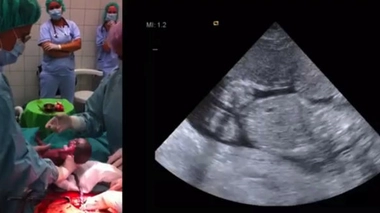 A gauche, la mise au monde de l'enfant par césarienne. A droite, l'une des échographies réalisées avant l'accouchement. (source : clinique de Debrecen)