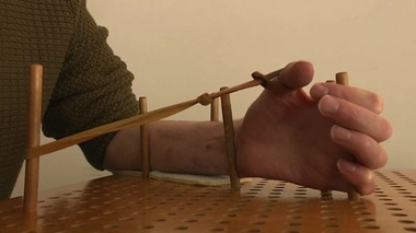 Paralysie du plexus brachial : les résultats de la chirurgie