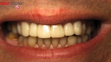 Dents : ''2 brossages par jour au lieu de 3, bonjour les dégâts !''