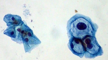 A gauche, une cellule saine. A droite, une cellule infectée par le HPV.