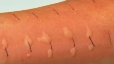 Ch@t : La rentrée des allergies