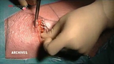 Peut-on recycler les pacemakers ?