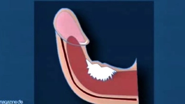 La maladie de La Peyronie. Des plaques dures et fibreuses, ici en blanc, sont responsables de la déviation du pénis lors de l’érection.