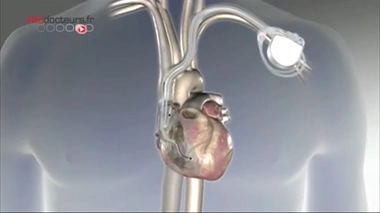 Vidéo - Un stimulateur au cœur du cœur