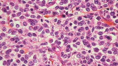 L'immunothérapie contre le cancer, avancée scientifique de l'année