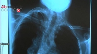 Quelques secondes pour dépister la scoliose de votre enfant