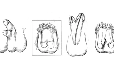 Différents degrés de diphallia, illustrés par Johnson en 1974. (Source : Illustrated Encyclopedia of Human Anatomic Variation)