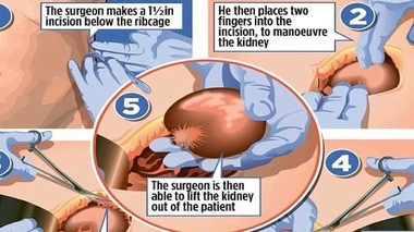 1. Le chirurgien fait une incision de 4 cm 2.Il place deux doigts dans l'abdomen pour mobiliser le rein 3.Il le sépare du tissu conjonctif 4.Les vaisseaux sanguins et l'uretère sont coupés 5.Le rein est extrait du patient.Infographie du DailyMail
