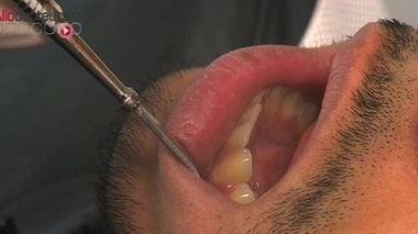 Le dentiste manquait d'hygiène : 22.000 patients rappelés pour dépistage