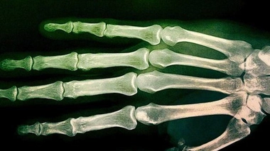 Migrants mineurs : les examens osseux devant la Cour de cassation