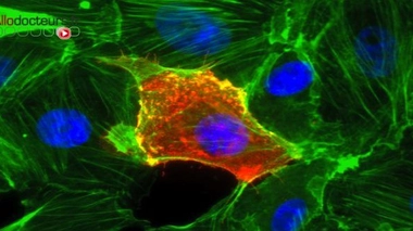 Chikungunya, la maladie du marcheur courbé