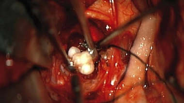 Extraction de l'une des dents par les chirurgiens du Maryland (source : NEJM)