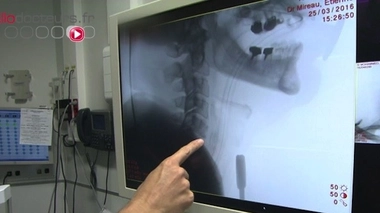 Hernie cervicale : tordre le cou à la douleur