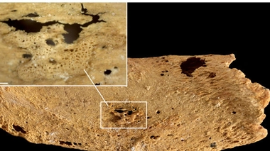L'un des nombreux os présentant des traces de lésions cancéreuses sur le squelette (ici, une côte). Le squelette a été découvert sur le site de Amara West, à 750 km au sud de Khartoum (Soudan).