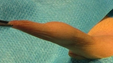 Cinq questions sur la circoncision