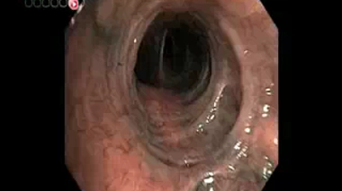 Cancer : 30% des actifs sans emploi deux ans après le diagnostic