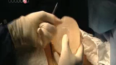 Les implants mammaires ont une durée de vie limitée