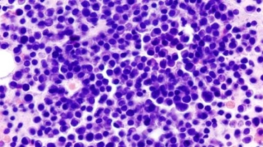 Cellules cancéreuses dans la moëlle osseuse (cc by sa KGH)