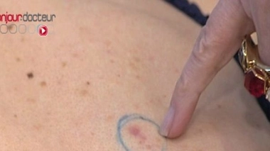 Cancers de la peau : profitez du dépistage gratuit&nbsp;!