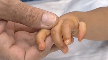 Naître sans pouce : l'index à la rescousse !