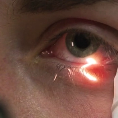 Conjonctivite, kératite, uvéite : attention les yeux !