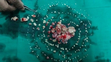 Insolite : un jeune Indien se fait arracher 232 dents