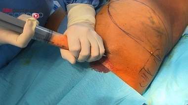 Brésil : nouveau leader mondial de la chirurgie esthétique