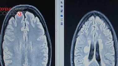 Sclérose en plaques : l'Etat condamné à verser 2,4 millions d'euros d'indemnités